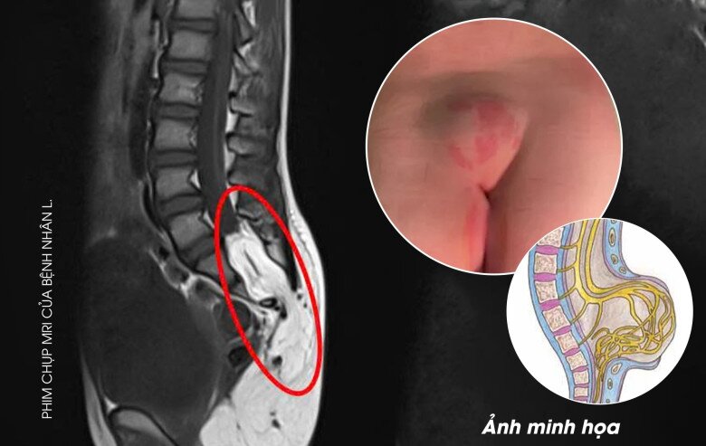 Để xác định chính xác dị tật hiếm gặp này cần phải chụp MRI cột sống. Ảnh: TTCC. 