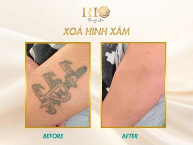 Xóa hình xăm không để lại sẹo và bí mật đằng sau