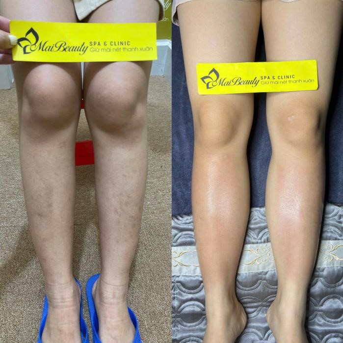 Hình ảnh khách hàng trước và sau khi làm đẹp tại Mai Beauty