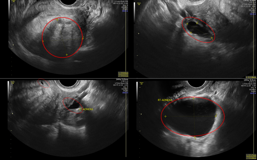 Siêu âm cho thấy chị H có nhiều khối lạc nội mạc cùng các nang buồng trứng.