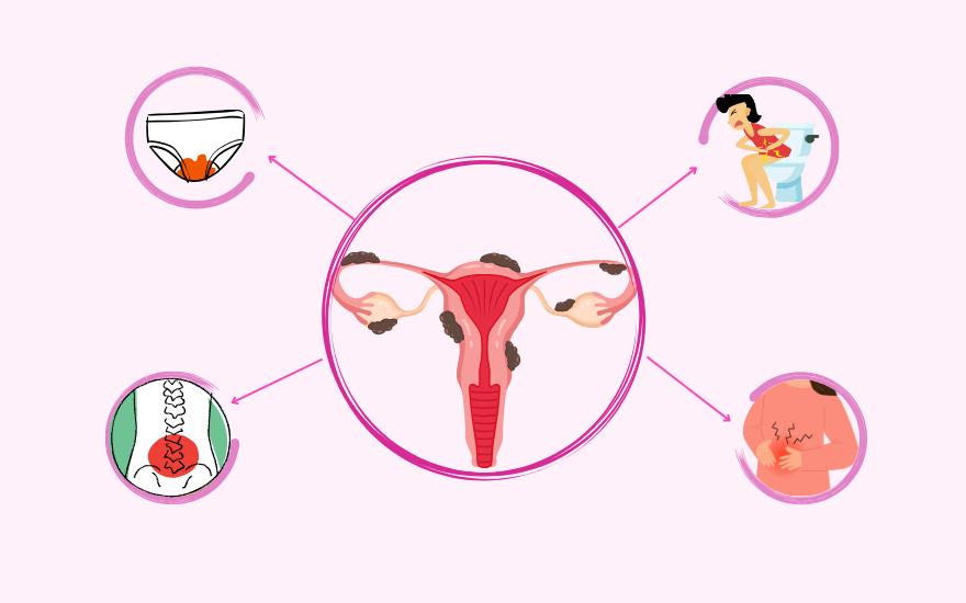 Lạc nội mạc tử cung thường gây đau bụng kéo dài, đau lưng và rong kinh.