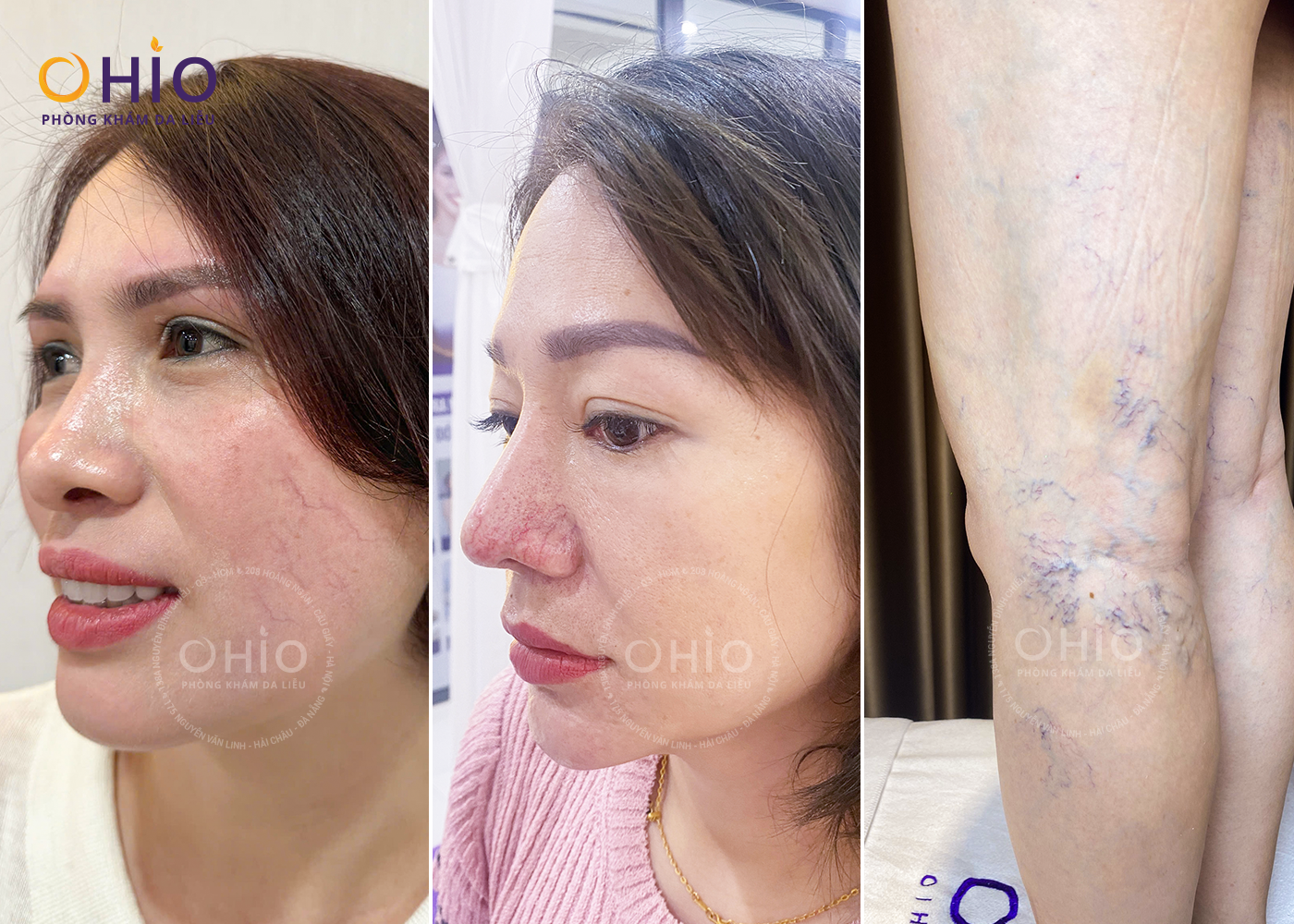 Tình trạng giãn mao mạch má, mũi, chân đùi