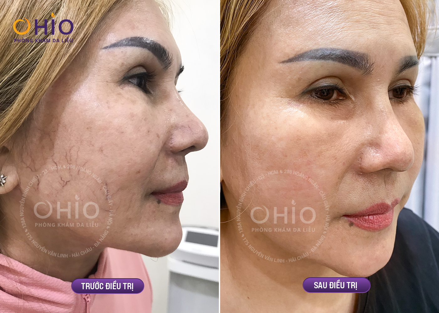 Trước và sau trị giãn mao mạch bằng tổ hợp laser xung dài