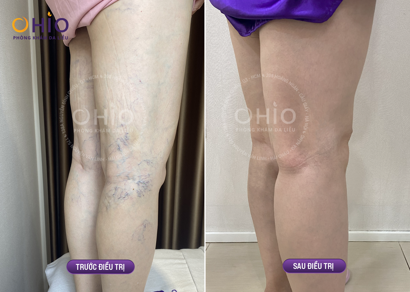 Trước và sau trị giãn mao mạch bằng tổ hợp laser xung dài