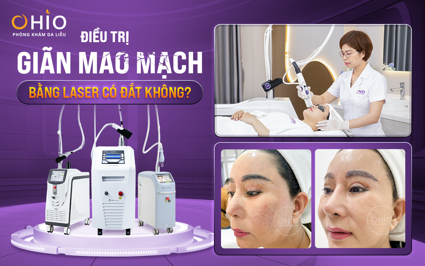 Tổ hợp Laser xung dài trị giãn mao mạch hiệu quả, an toàn