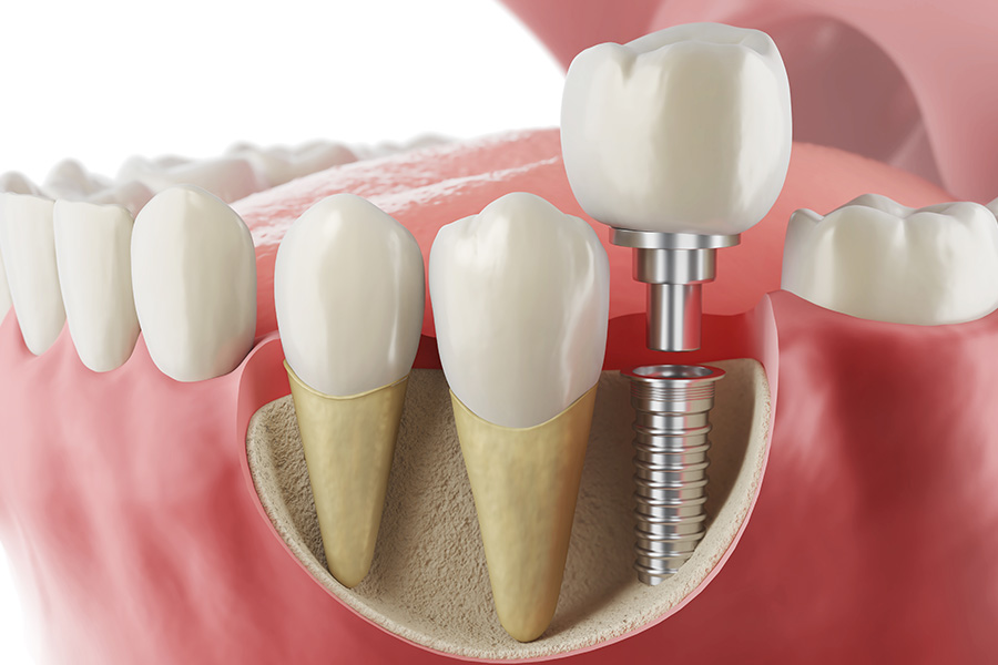 Trồng răng Implant