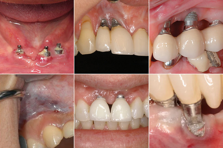 Trồng răng Implant miễn phí có thể dẫn đến các biến chứng nguy hiểm