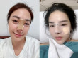 "Trái đắng" của các mỹ nhân Việt khi sửa mũi: Đệ nhất dao kéo làm hơn chục lần vẫn chưa ưng, một người biến chứng nặng sau 12 năm