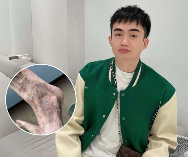 Tina Thảo Thi chia sẻ hình ảnh chân bị viêm mao mạch hoại tử. 