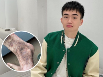 Căn bệnh Tina Thảo Thi mắc phải khiến chân như bị ghẻ nguy hiểm thế nào? Liệu có chữa khỏi hoàn toàn được không?