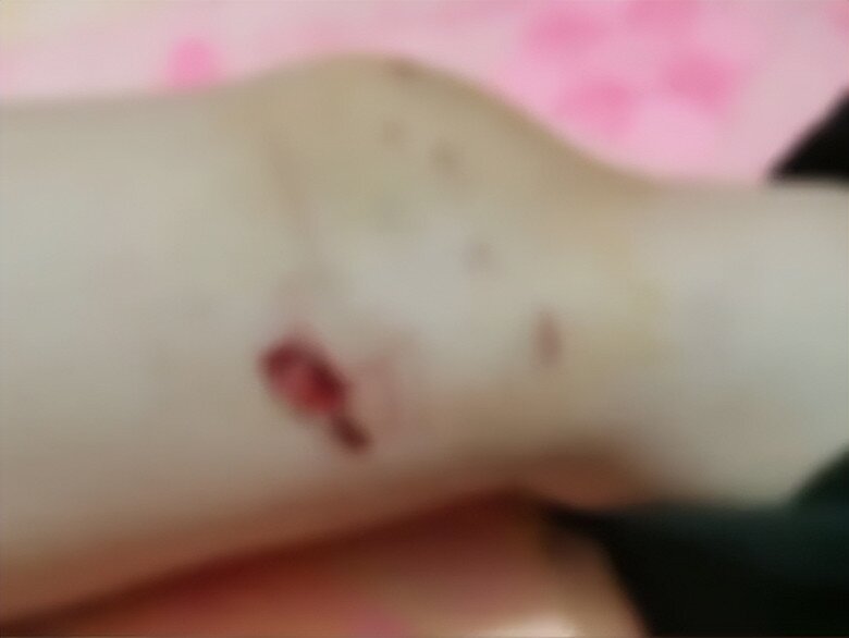 Bé gái 5 tuổi bị chó nhà hàng xóm bất ngờ tấn công, húc ngã xuống đất khi đi bộ trên đường, phải nhập viện gấp - 3