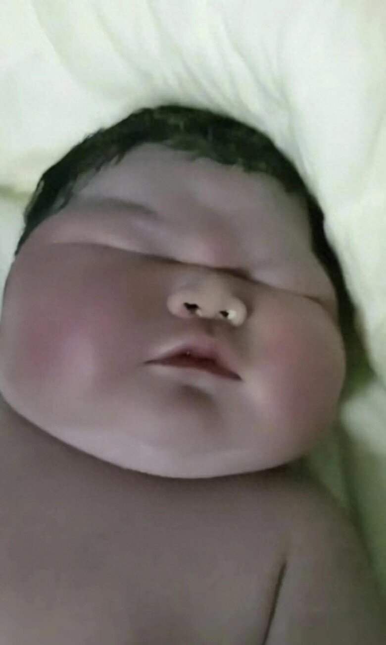Bé sơ sinh chào đời da tím tái, nặng 13 kg, bác sĩ đỡ đẻ nhìn thấy liền thốt lên: Không thể tin nổi - 2
