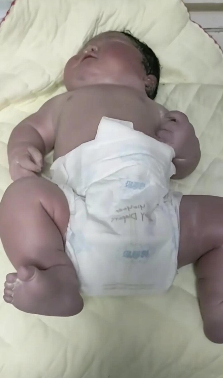 Bé sơ sinh chào đời da tím tái, nặng 13 kg, bác sĩ đỡ đẻ nhìn thấy liền thốt lên: Không thể tin nổi - 1