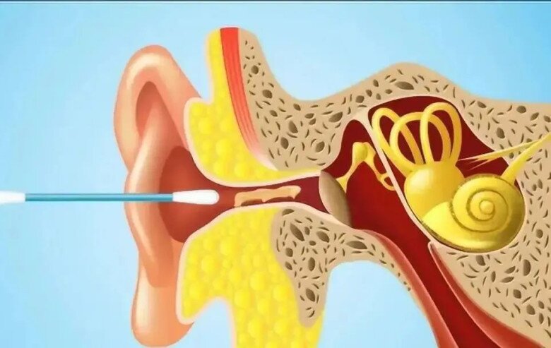 Bé trai 10 tuổi bị mất thính lực sau khi đi bơi về, đến bệnh viện bác sĩ đưa ra cảnh báo khẩn cấp - 2