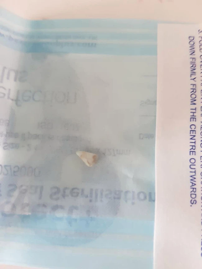 Con 3 tháng tuổi không ngừng khóc, mẹ phát hoảng khi thấy trong miệng con mọc răng nanh, đến bệnh viện bác sĩ lắc đầu - 4