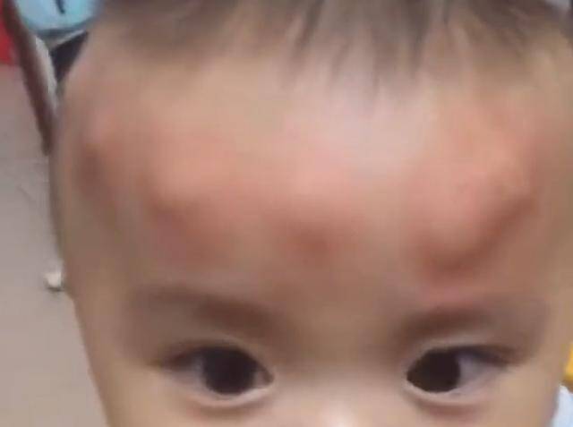Con trai 2 tuổi ngủ dậy trên đầu liền xuất hiện nhiều khối u bất thường, người mẹ tá hoả khi biết nguyên nhân - 2