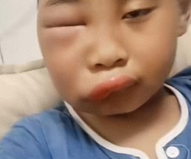 Gửi con về quê nghỉ hè với ông bà, ngày về đón mẹ tá hoả khi mặt đứa trẻ biến dạng - 1