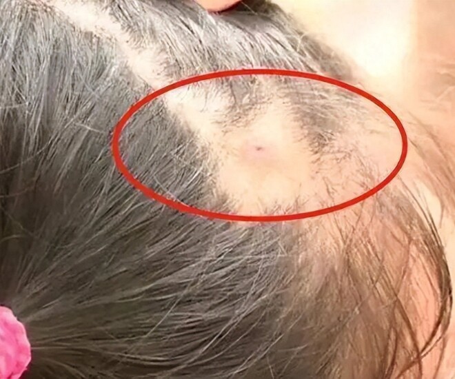 Mẹ phát hiện trên đầu con xuất hiện một lỗ sâu kỳ lạ liền đưa đi khám, đến bệnh viện bác sĩ nói: “Đứa trẻ quá may mắn” - 1