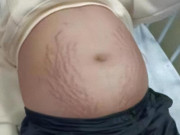 Yêu con - Mẹ nghi con gái lớp 3 mang thai vì bụng to bất thường, đi khám bác sĩ kết luận 5 chữ khiến mẹ gục ngã