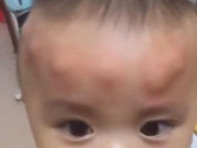 Yêu con - Con trai 2 tuổi ngủ dậy trên đầu liền xuất hiện nhiều khối u bất thường, người mẹ tá hoả khi biết nguyên nhân