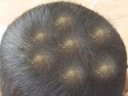Yêu con - Mẹ phát hiện trên đầu con xuất hiện 7 vòng xoáy kỳ lạ, lo lắng đưa đến viện khám, bác sĩ thốt lên: Thật hiếm gặp!