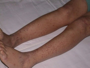 Yêu con - Tắm cho con gái, mẹ phát hiện chân đứa trẻ nổi loạt đốm đỏ, kết quả khám khiến gia đình đau khổ