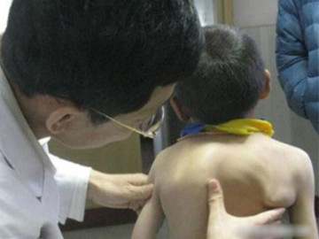 Mẹ phát hiện lưng con ngày càng biến dạng, biết nguyên nhân do thói quen của bà nội, người mẹ hối hận