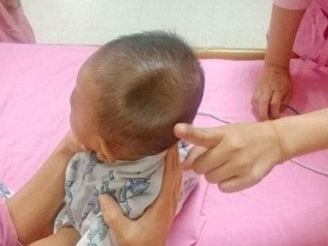 Bé trai 8 tháng tuổi gây xót xa khi đầu bị lõm xuống như một chiếc hố, chỉ vì sơ suất nhỏ của bố mẹ