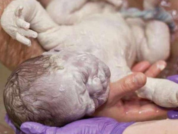 Bố mẹ phát hoảng khi con sơ sinh chào đời người trắng bệch, tưởng bệnh lạ nhưng bác sĩ lại vỗ tay chúc mừng