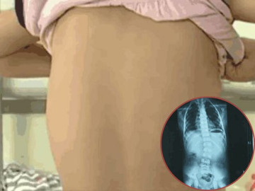 Tắm cho con gái, mẹ phát hiện lưng con có vấn đề, đến bệnh viện bác sĩ bắt phẫu thuật gấp