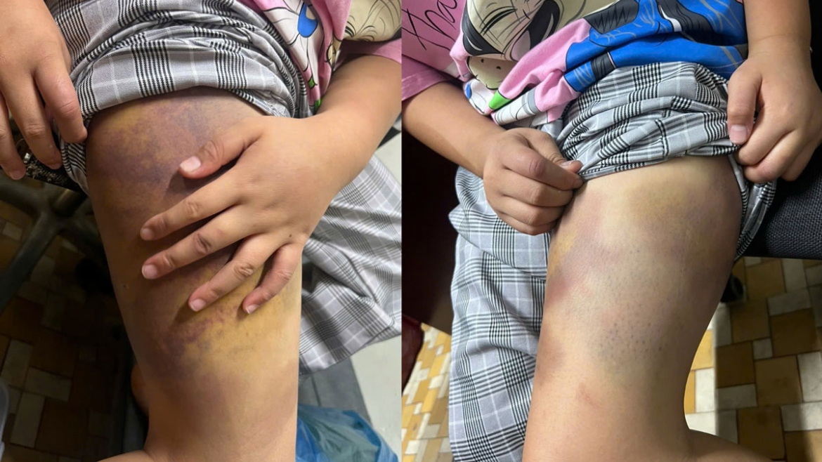 Bé L. bị Long đánh bầm tím (ảnh: CA)