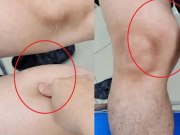 Đùi to bất thường suốt một năm, người đàn ông phát hiện ung thư hiếm gặp