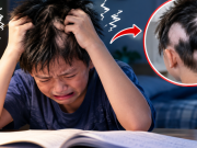 Clip Eva - Ôn thi căng thẳng, bé trai tự nhổ tóc đến trơ từng mảng da đầu