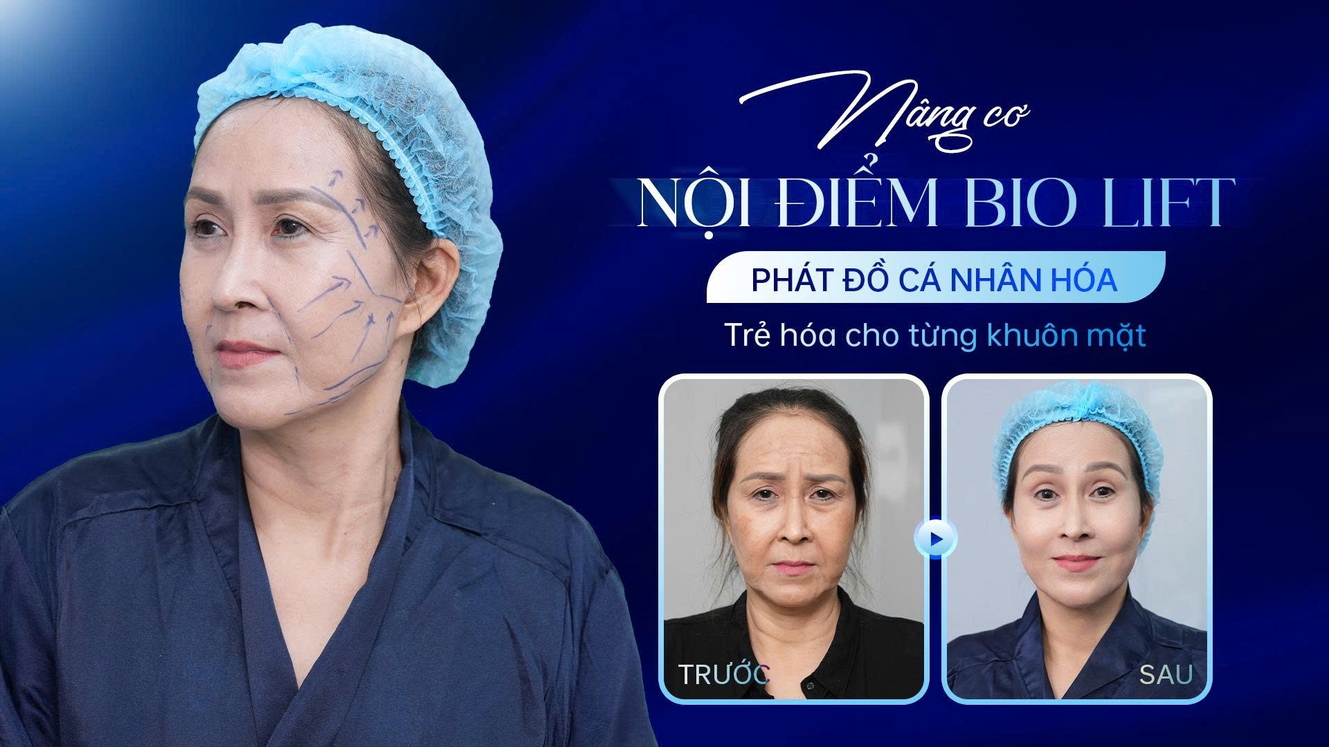 Nâng cơ nội điểm hướng đến việc hỗ trợ định hình những vùng có dấu hiệu chùng nhão và kém săn chắc.