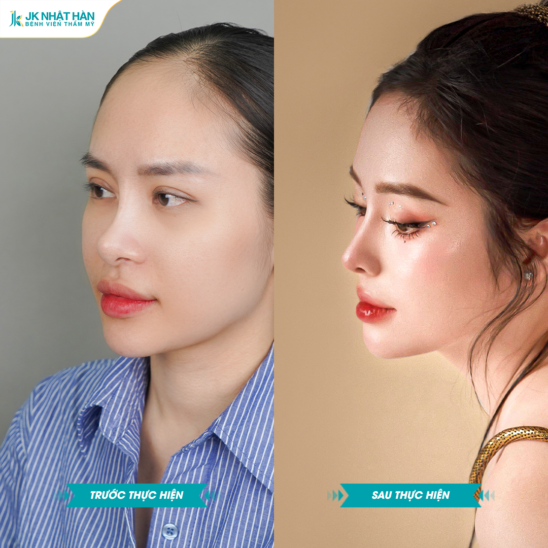 “Xóa mũi tẹt cho thanh thiếu niên Việt”: Hàng loạt bạn trẻ tự tin hơn sau nâng mũi sụn sườn J-Cos - 1