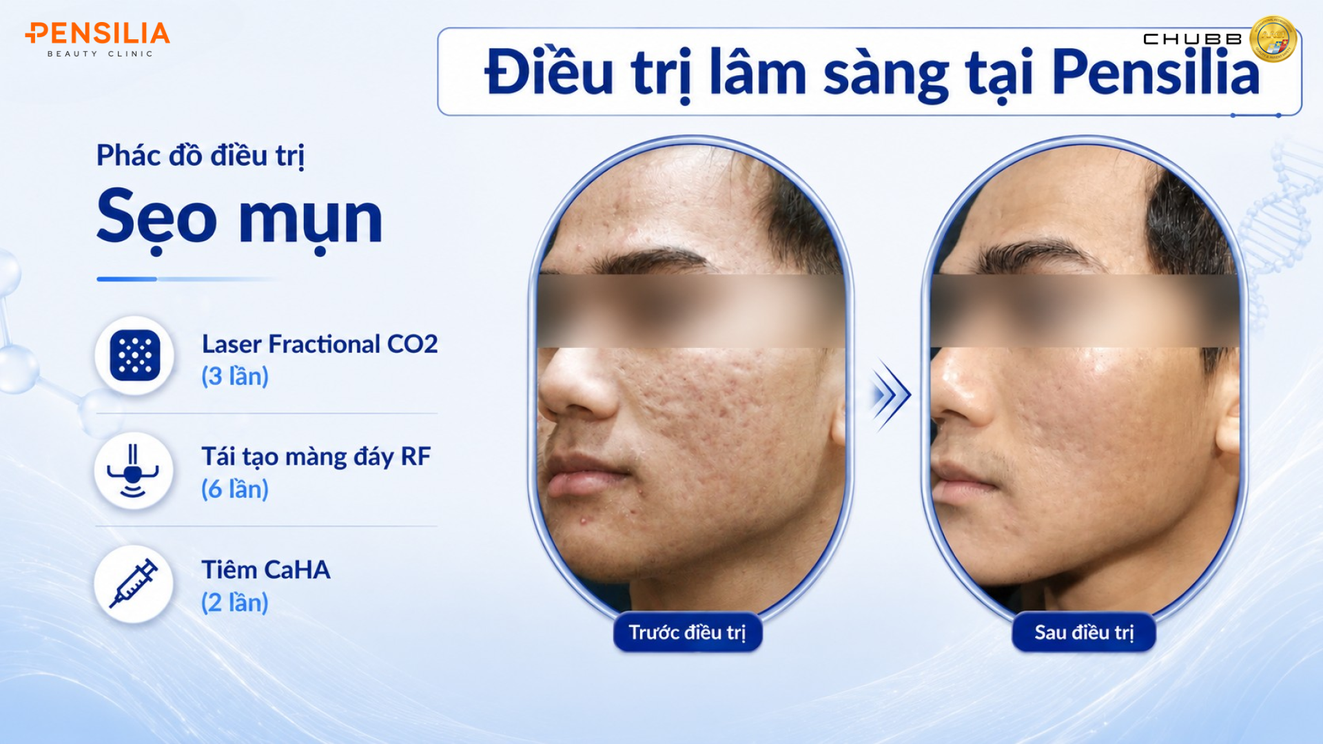 Phác đồ điều trị lâm sàng - sẹo mụn tại Pensilia