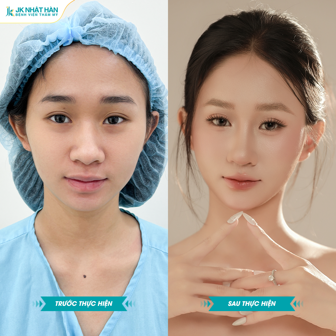 “Xóa mũi tẹt cho thanh thiếu niên Việt”: Hàng loạt bạn trẻ tự tin hơn sau nâng mũi sụn sườn J-Cos - 4