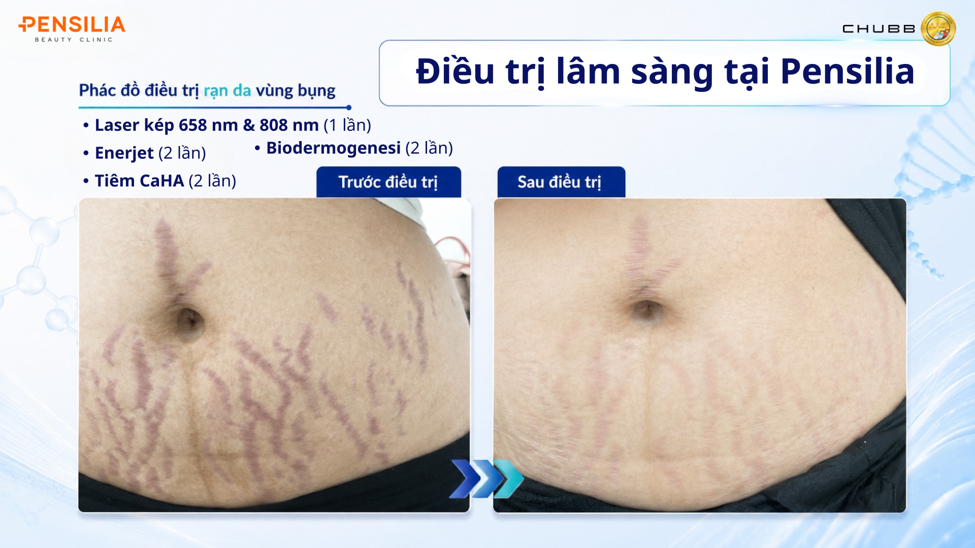 Phác đồ điều trị lâm sàng - rạn da vùng bụng tại Pensilia