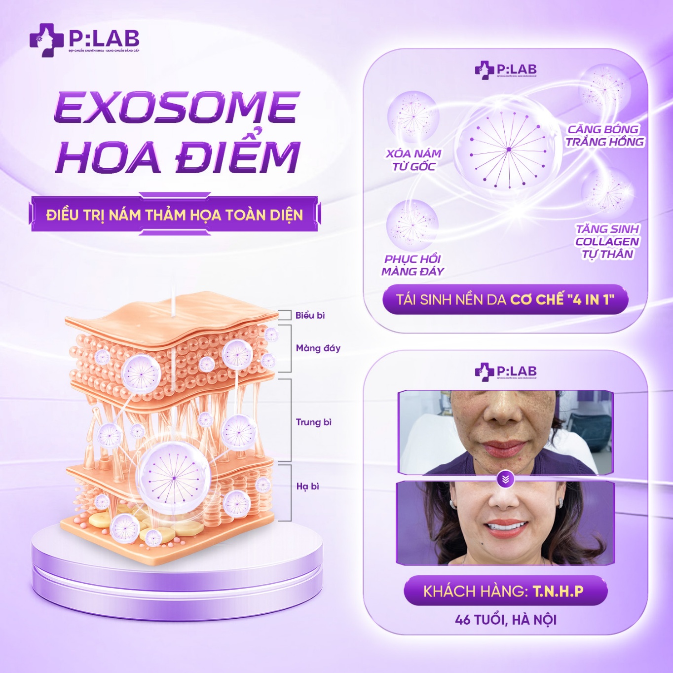 Hình ảnh minh họa cơ chế tác động 4in1 của Exosome Hoa Điểm lên màng đáy