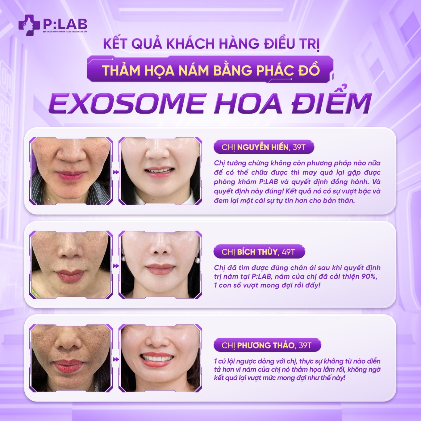 Kết quả khách hàng điều trị thảm hoạ nám bằng công nghệ Exosome hoa điểm