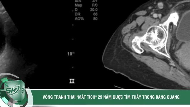 Vòng tránh thai 'mất tích' 29 năm bất ngờ được tìm thấy trong bàng quang