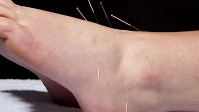 Đau chân dữ dội sau châm cứu, người phụ nữ sốc nặng khi biết nguyên nhân