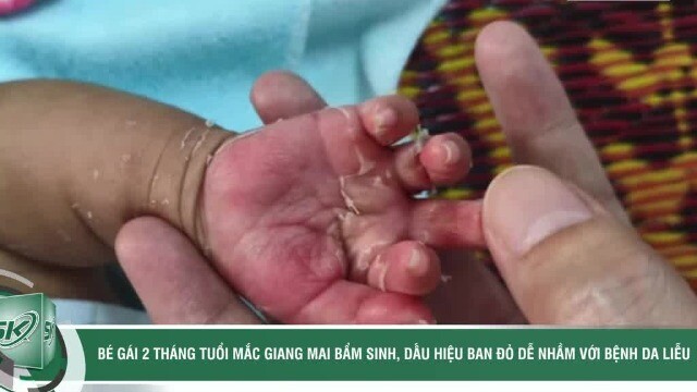 Tưởng bệnh da liễu, bé 2 tháng tuổi mắc giang mai