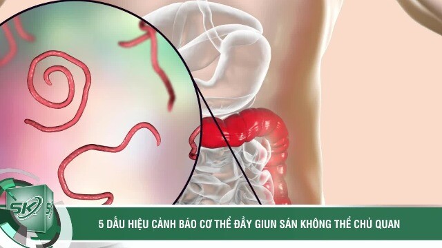 5 dấu hiệu cảnh báo cơ thể đầy giun sán không thể chủ quan