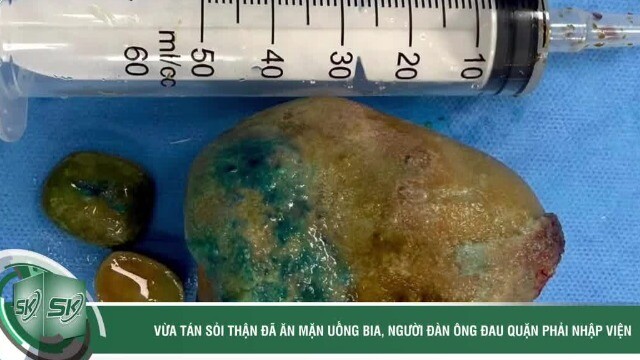 Vừa tán sỏi thận đã ăn mặn uống bia, người đàn ông đau quặn thận