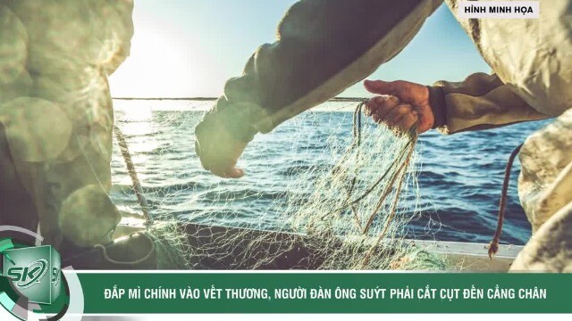 Đắp mì chính vào vết thương, người đàn ông suýt phải cắt cụt đến cẳng chân