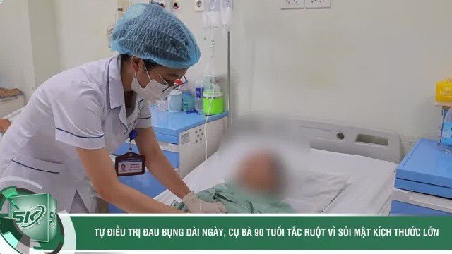 Tự điều trị đau bụng dài ngày, cụ bà tắc ruột vì sỏi mật kích thước lớn