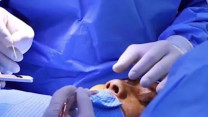 Nâng mũi xong gặp tai nạn, người phụ nữ đối mặt nguy cơ hoại tử mũi