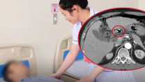 Người đàn ông 42 tuổi đau bụng dữ dội, suýt phải cắt dạ dày vì tổn thương nghi ung thư