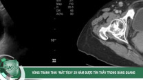 Vòng tránh thai 'mất tích' 29 năm bất ngờ được tìm thấy trong bàng quang